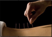 Traditional Acupuncture Treatments